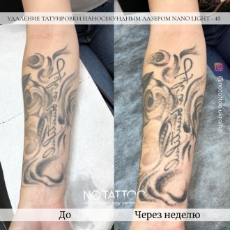 Лазерное удаление тату и татуажа наносекундным и пикосекундным лазерами. Київ. фото 1 Лазерное удаление тату и татуажа наносекундным и пикосекундным лазерами. Київ. фото 1
