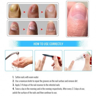 OMYLADY High Quality Nail Protector Skin Care ESSENCE Cream Крем для лечения гри. . фото 4